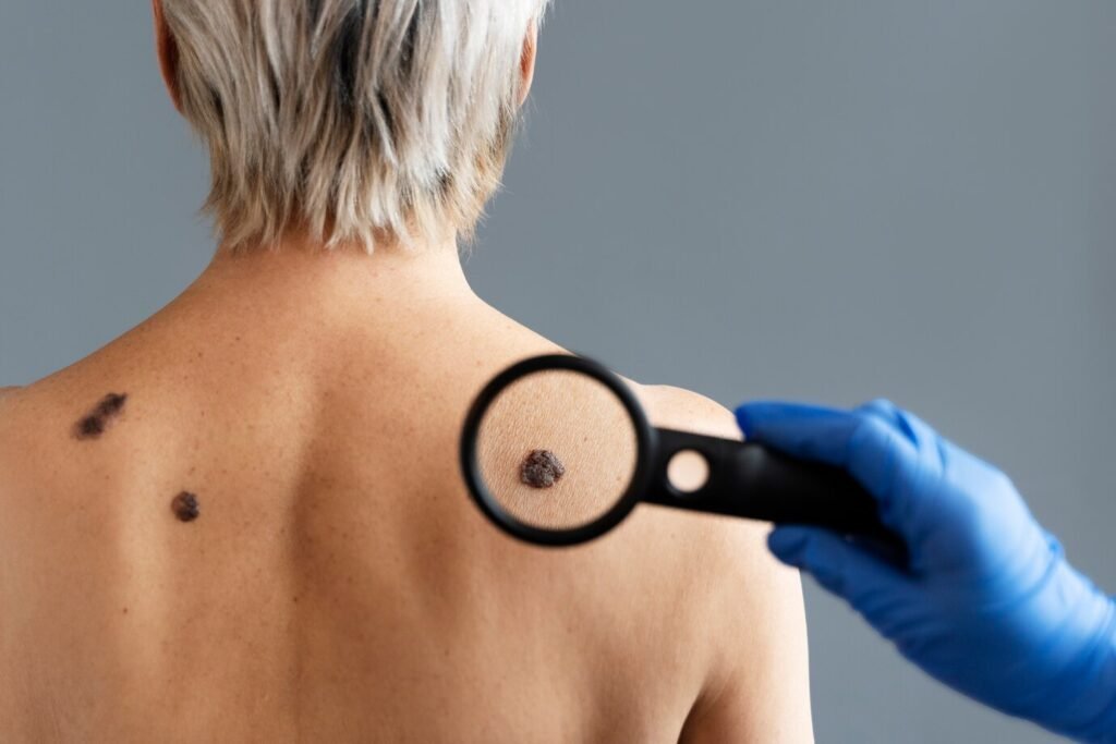 05 Skin Cancer Symptoms: A Comprehensive Guide 6 Melanoma
