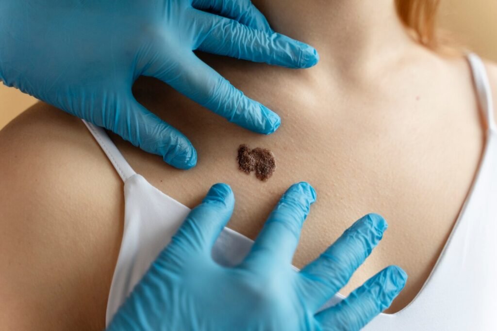 Comprehensive Guide to 05 Skin Cancer Treatment: Understanding Your Options 3 Skin Cancer Treatment
